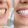 Sammenligning af gule tænder og hvide tænder efter whitening-behandling