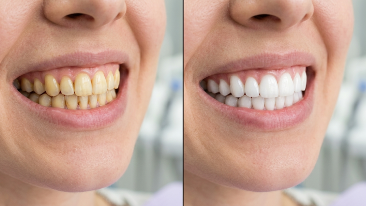 Sammenligning af gule tænder og hvide tænder efter whitening-behandling